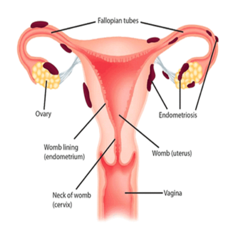 WHAT IS ENDOMETRIOSIS?