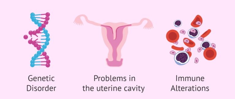 Recurrent Miscarriage
