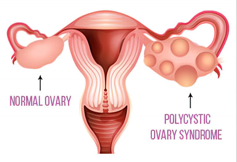 What is PCOS?
