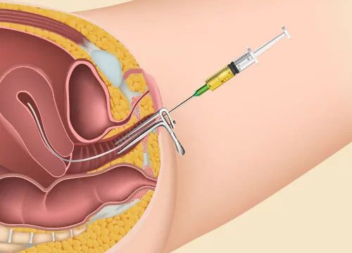 Intrauterine Insemination (IUI) fertility treatment