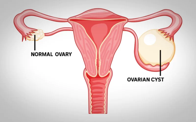 Illustration of ovarian cysts in the ovaries