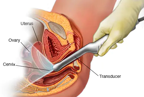 Intrauterine Insemination (IUI)